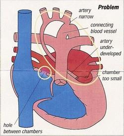 HLHS Heart copy.jpg